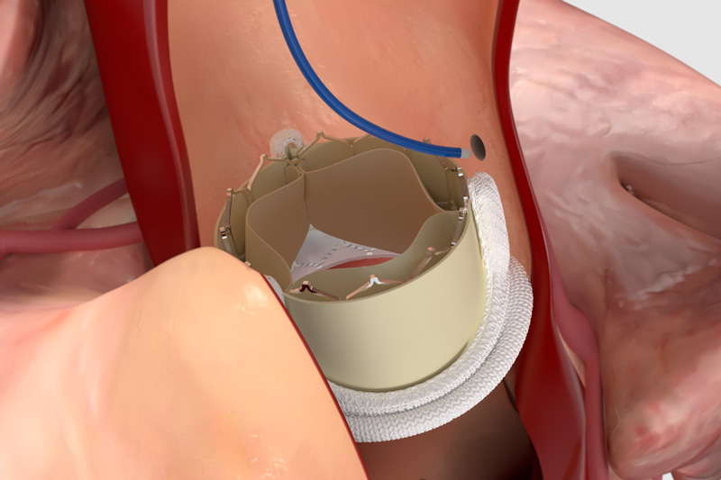 バルーン拡張型人工弁TAV in SAV.jpg