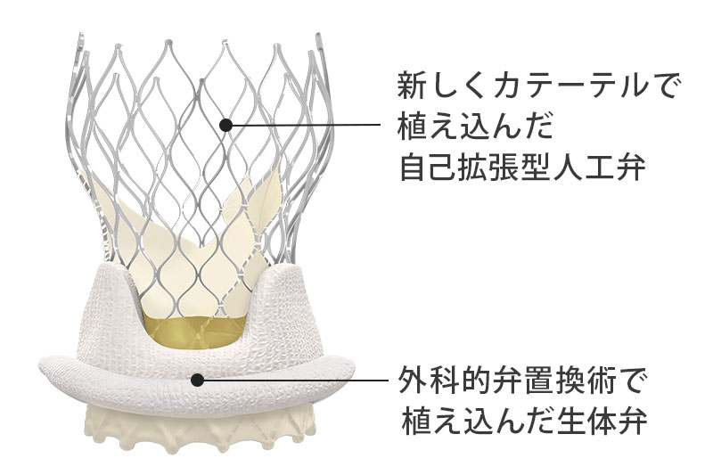 自己拡張型人工弁TAV in SAV.jpg