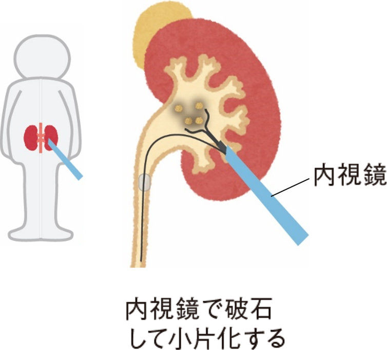 手術イメージ