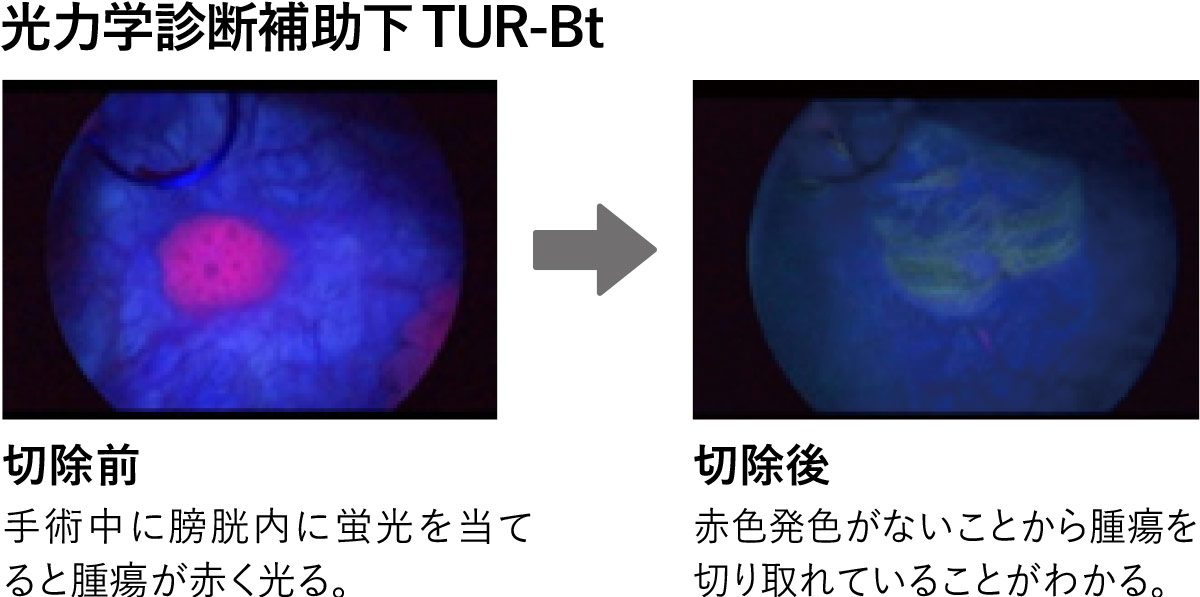 尿管結石砕石術 手術実績