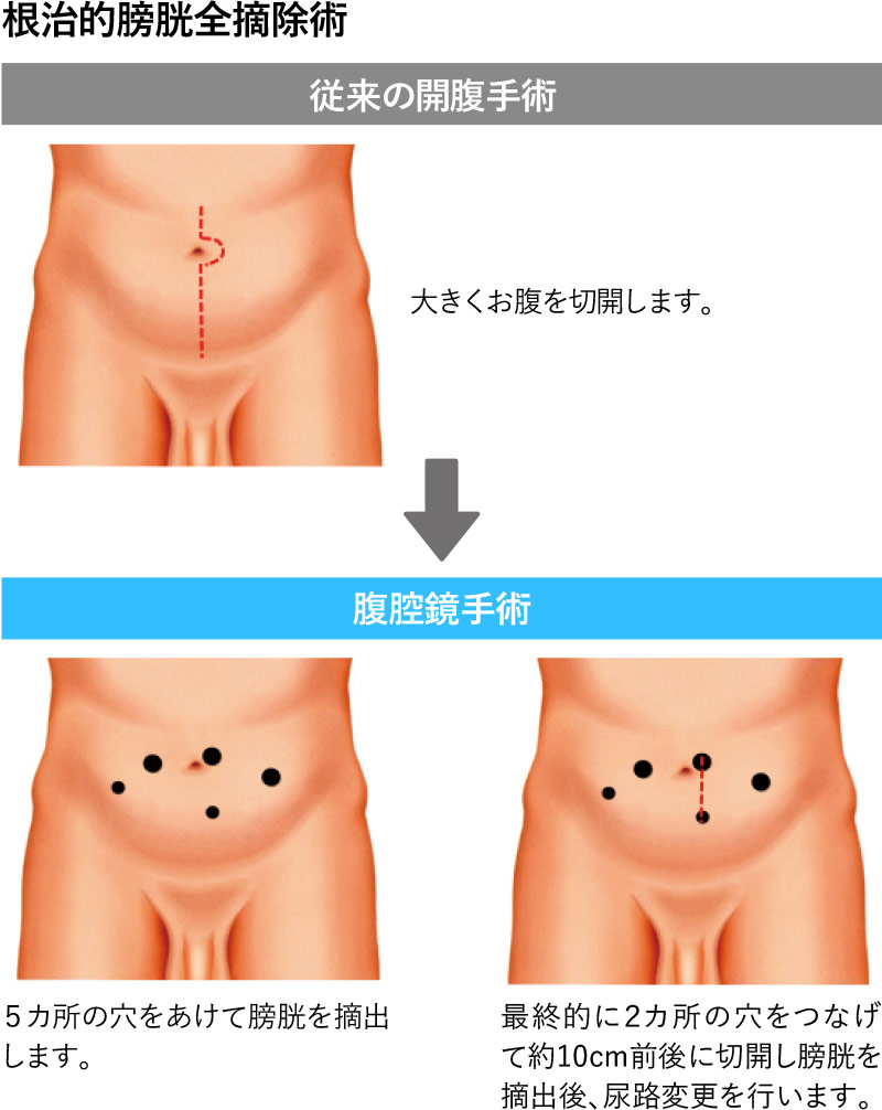 尿管結石砕石術 手術実績