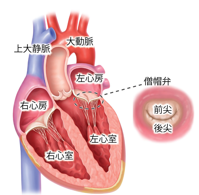 MitraClip模式図.jpg