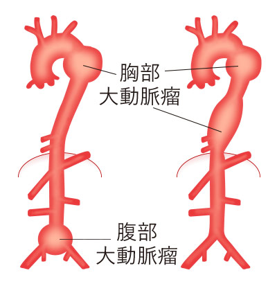 大動脈瘤の部位による分類