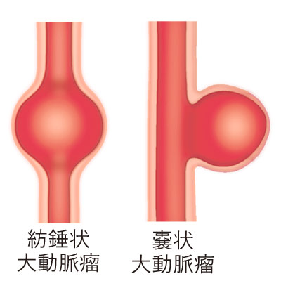 大動脈瘤の形状による分類