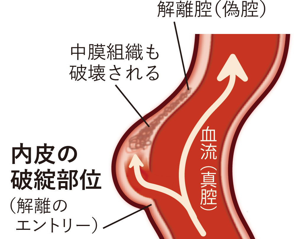 大動脈解離の発生