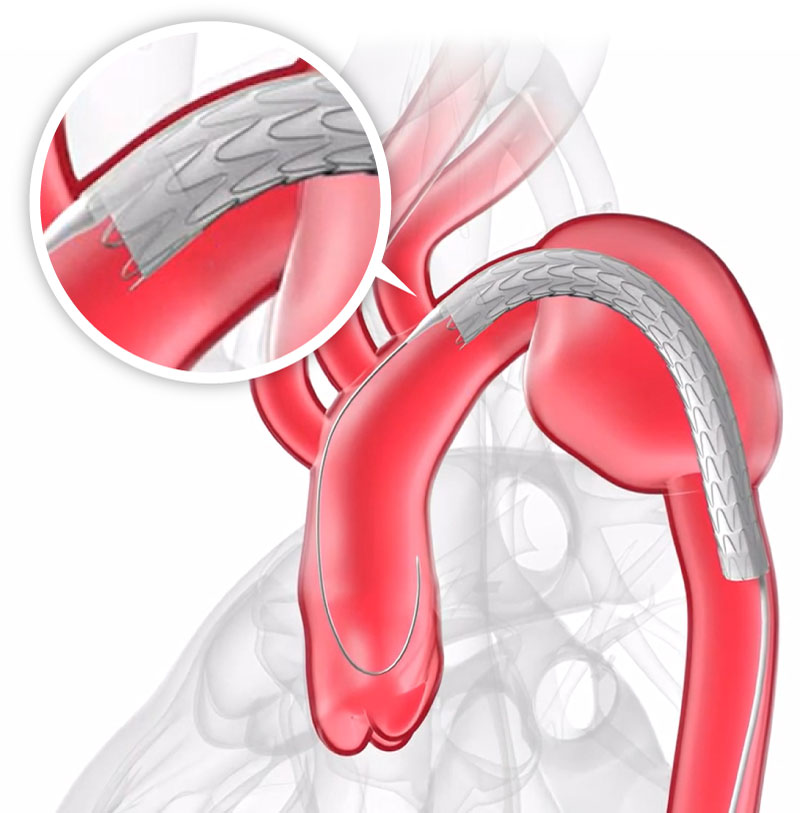 大動脈ステントグラフト展開前