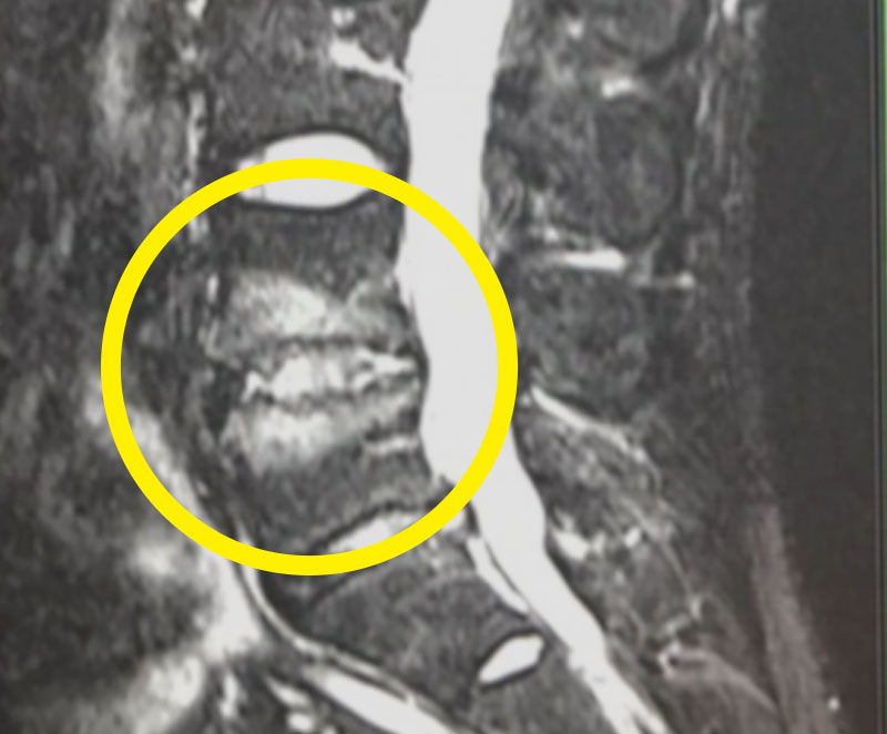 Modic変性の患部レントゲン