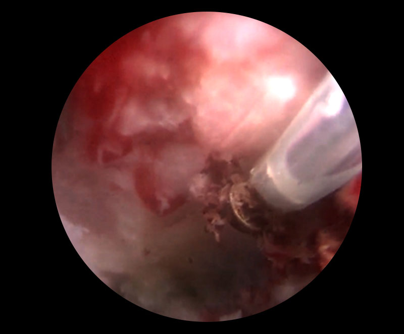 Modic変性に対する全内視鏡下脊椎手術イメージ