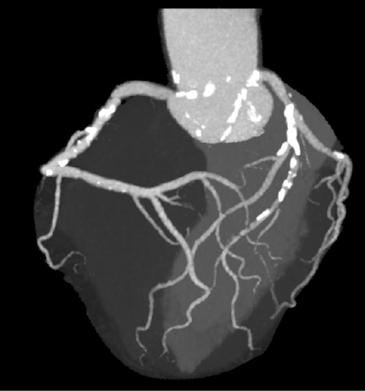 冠動脈CTデータ