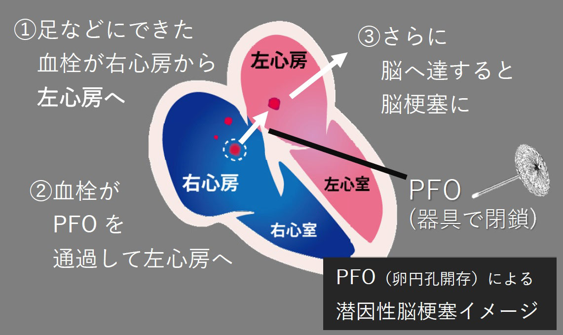 卵円孔開存（PFO）図